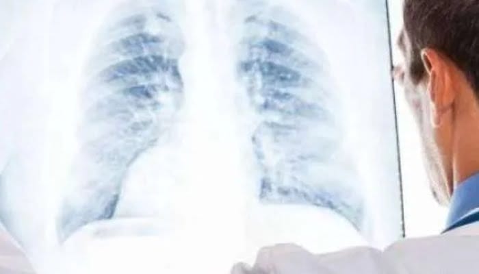 10 Besar Rawat Inap Terbanyak, Ini 8 Cara Mencegah Penyakit Pneumonia