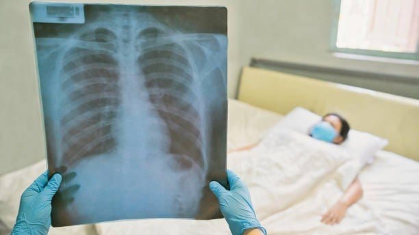 Paru-paru basah, yang dikenal secara medis sebagai pneumonia, adalah peradangan pada salah satu atau kedua paru-paru yang disebabkan oleh infeksi. Infeksi ini dapat disebabkan oleh bakteri, virus, atau jamur, dan menyebabkan penumpukan cairan di kantong udara (alveoli) di paru-paru.