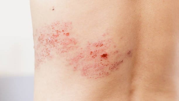 Penyakit cacar api atau herpes zoster. (Foto: Pixabay)