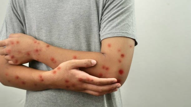 Salah satu faktor risiko utama penularan Mpox adalah kontak langsung dengan lesi kulit yang terinfeksi, cairan tubuh, atau benda yang terkontaminasi oleh cairan tubuh dari individu yang terinfeksi.