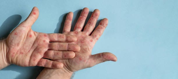 Male hands with Monkeypox rash. Patient with MonkeyPox viral disease. Close Up of Painful rash, red spots blisters on the skin. Human palm with Health problem. Banner, copy space. Allergy, dermatitis. Ill eczema skin of patient. Viral Diseases. Red rashes on the palm. Enterovirus. coxsackie